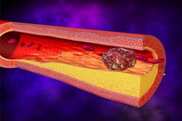 Cách phòng ngừa nguy cơ đột quỵ từ chuyên gia