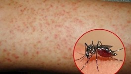 Cách phân biệt sốt xuất huyết với sốt virus và sốt phát ban