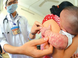 Việc cần làm khi trẻ sốt phát ban