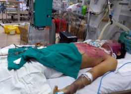 Một bệnh nhân thủy đậu cực nặng liên quan dùng sai thuốc