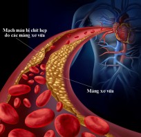 Cách ngăn ngừa rối loạn lipid máu