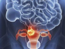 Những yếu tố nguy cơ gây ung thư nội mạc tử cung